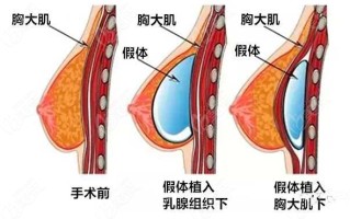 1月13日直播隆胸,隆胸手术直播录像