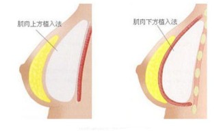 隆胸隆胸有什么危害和后遗症吗