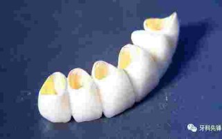 黄金烤瓷牙,黄金烤瓷牙和全瓷牙哪个好