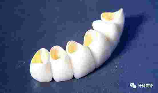 黄金烤瓷牙,黄金烤瓷牙和全瓷牙哪个好-第1张图片-翡翠网 黄金烤瓷牙,黄金烤瓷牙和全瓷牙哪个好-第1张图片-翡翠网