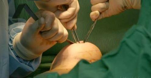 直播隆胸手术过程,直播隆胸手术过程图-第1张图片-翡翠网