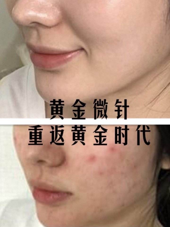 黄金微针的功效和作用价格黄金微针的功效和作用-第1张图片-翡翠网 黄金微针的功效和作用价格黄金微针的功效和作用-第1张图片-翡翠网