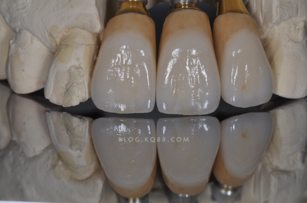 黄金烤瓷牙,黄金烤瓷牙图片-第2张图片-翡翠网 黄金烤瓷牙,黄金烤瓷牙图片-第2张图片-翡翠网